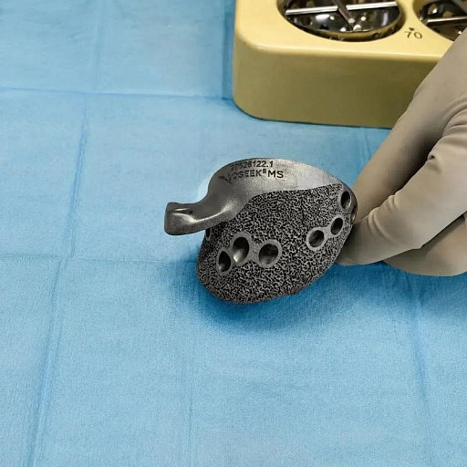 Врачи Сургута восстановили тазобедренный сустав с помощью 3D-импланта
